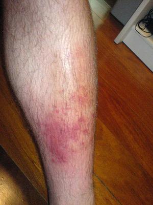 Cellulitis on the leg (picture from Wikipedia)